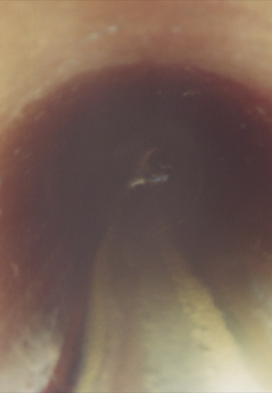 tunnelblick oder was